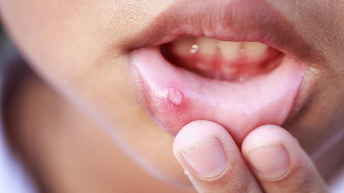 Mouth sores examination and treatment in Hyderabad