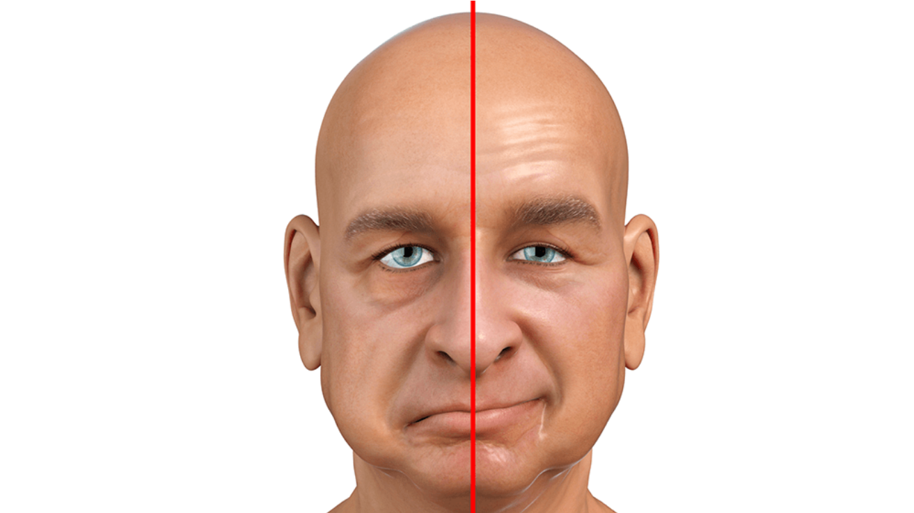 Bell's palsy facial nerve evaluation in Hyderabad