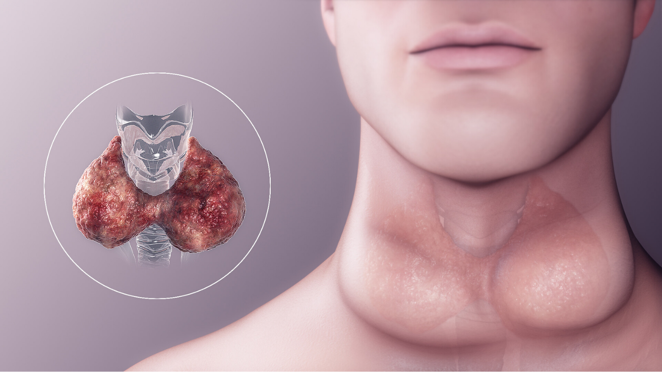 Hypothyroidism consultation and thyroid therapy in Hyderabad