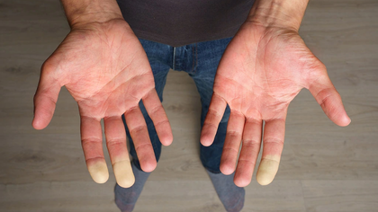 Scleroderma (systemic sclerosis) evaluation in Hyderabad