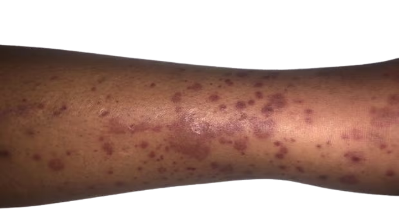 Thrombocytopenia (low platelets) evaluation in Hyderabad