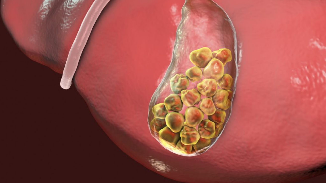 Cholecystitis gallbladder inflammation evaluation in Hyderabad