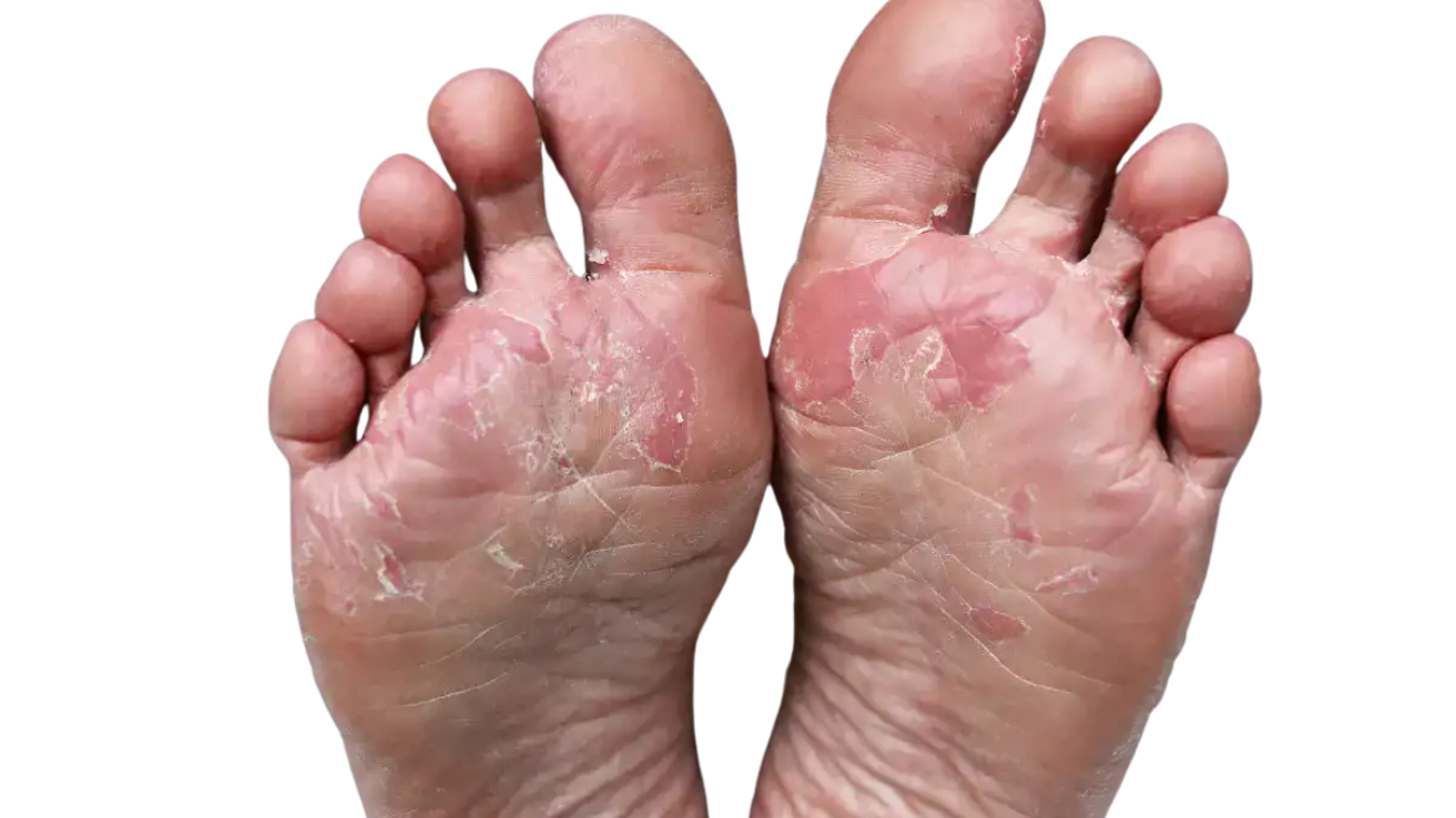 Diabetic foot infection wound care and treatment in Hyderabad