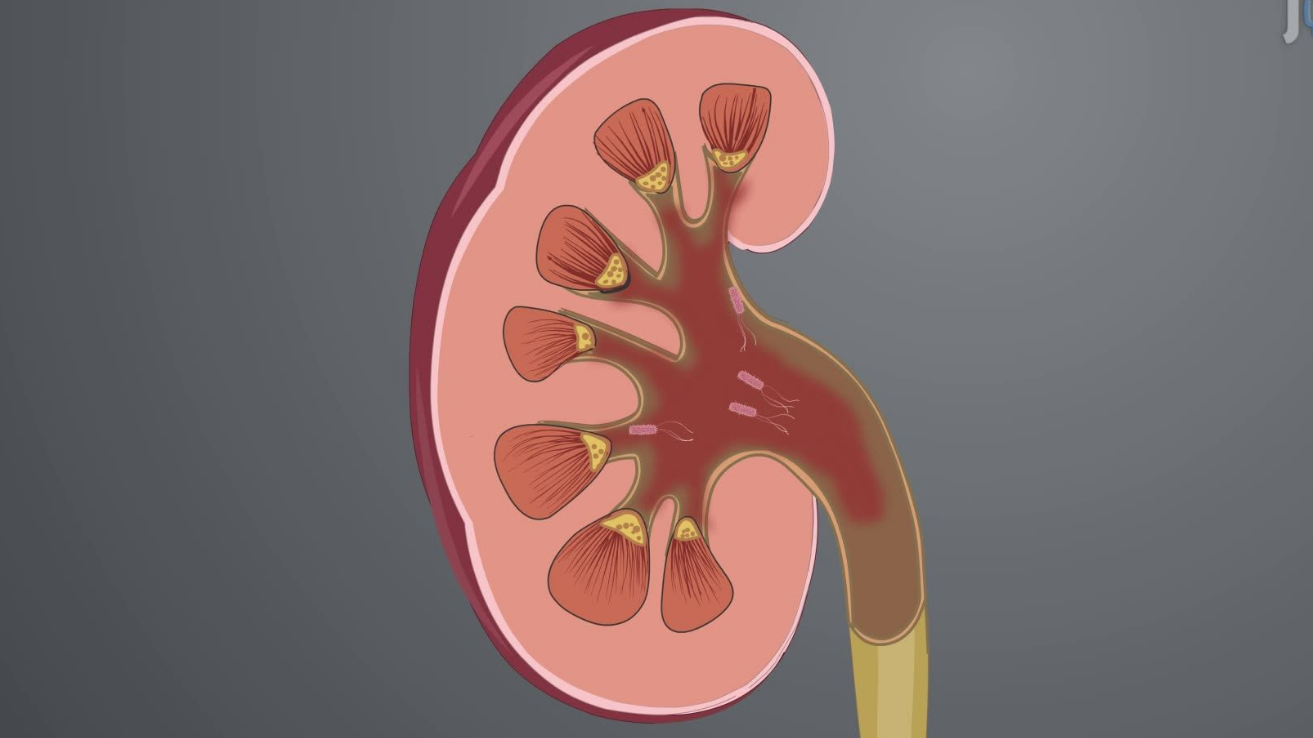 Pyelonephritis kidney infection evaluation in Hyderabad