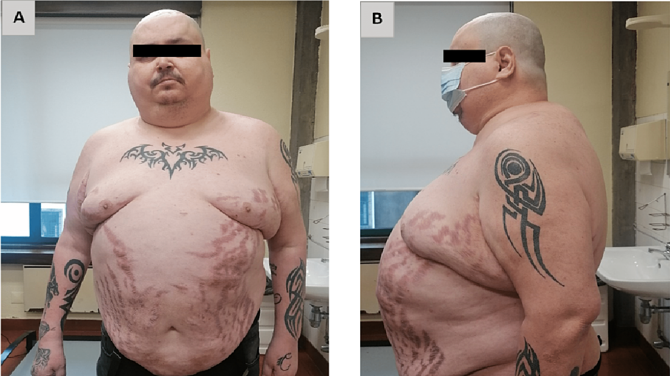Cushing's syndrome assessment and cortisol testing in Hyderabad