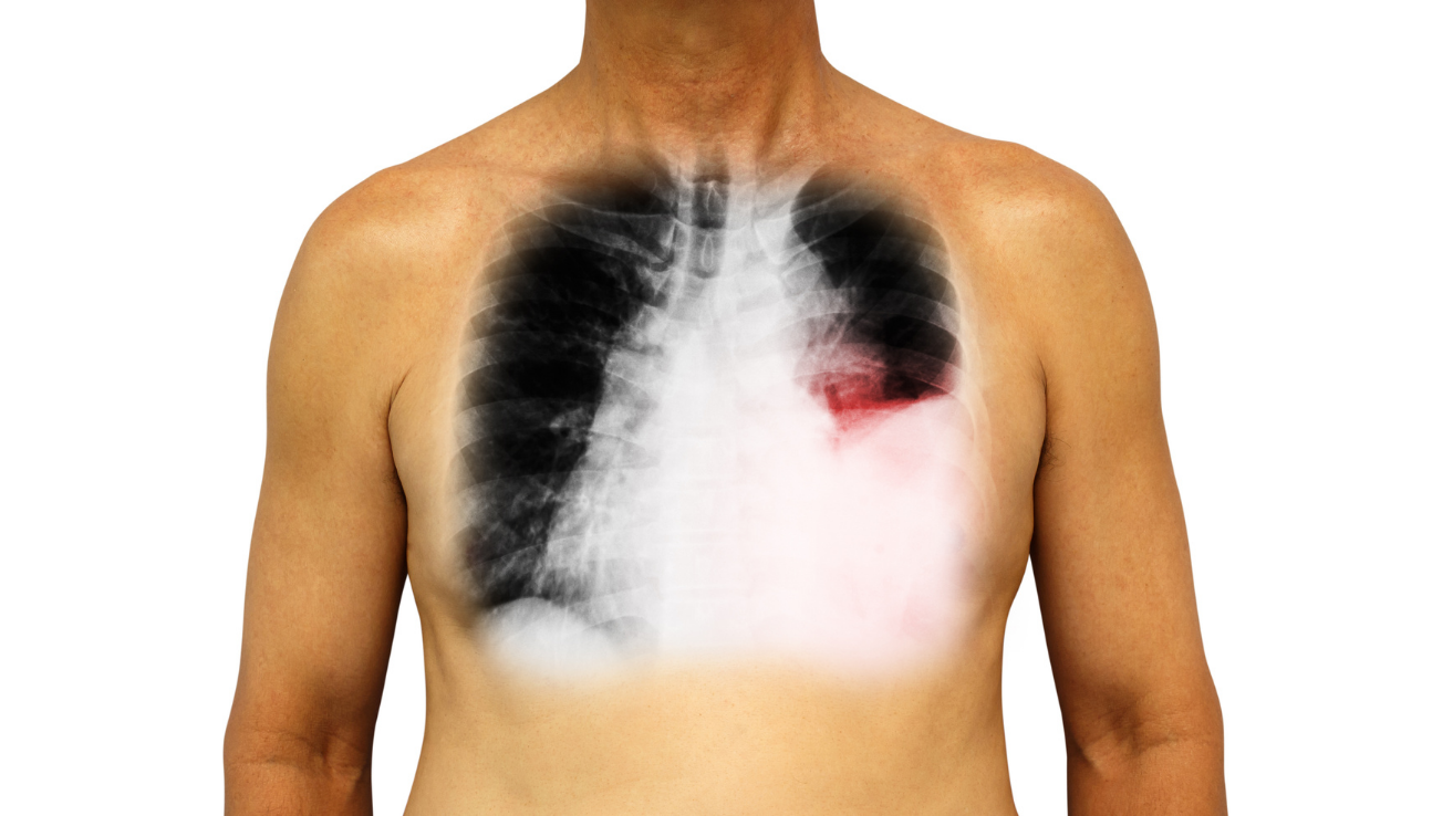 Pleural effusion chest evaluation and care in Hyderabad