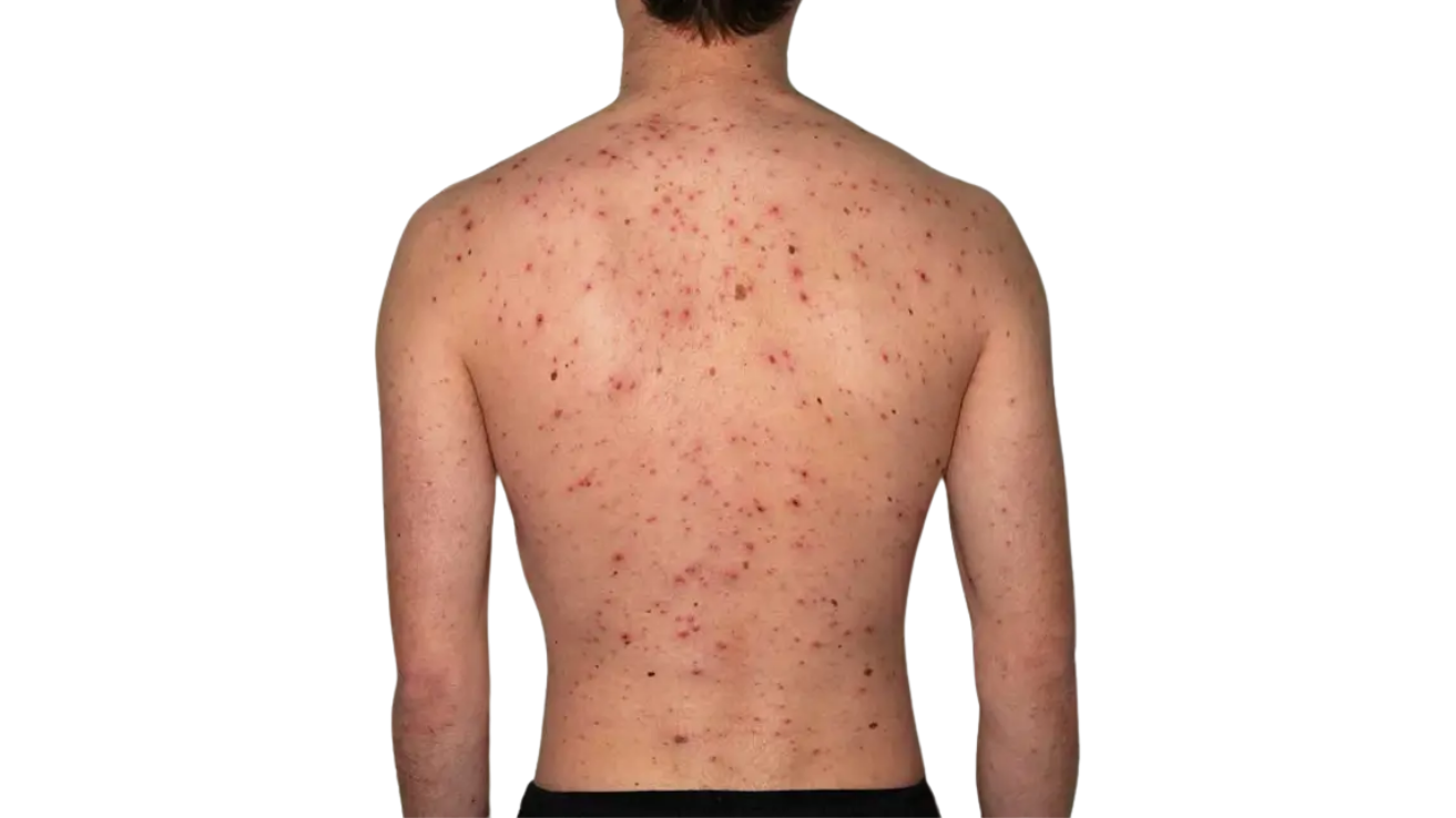 Chickenpox (varicella) rash evaluation and treatment in Hyderabad