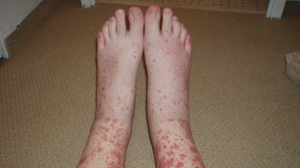 Vasculitis evaluation and specialist care in Hyderabad