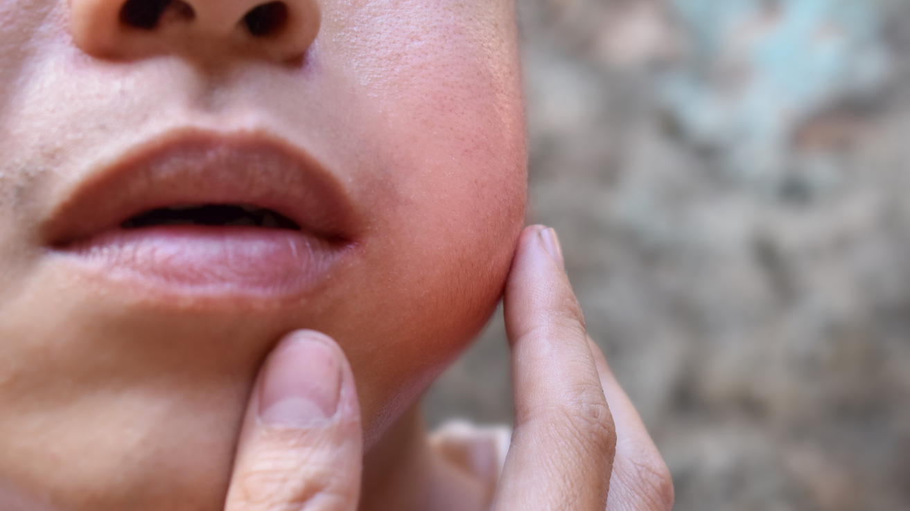 Mumps gland swelling evaluation in Hyderabad
