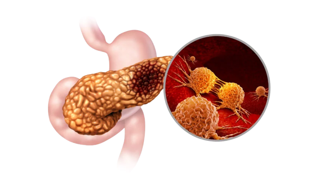 Acute pancreatitis emergency abdominal care in Hyderabad