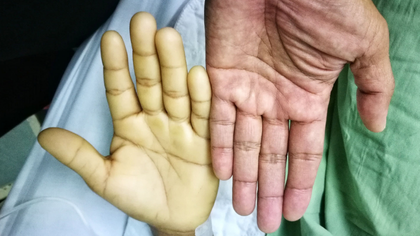 Aplastic anaemia evaluation and care in Hyderabad