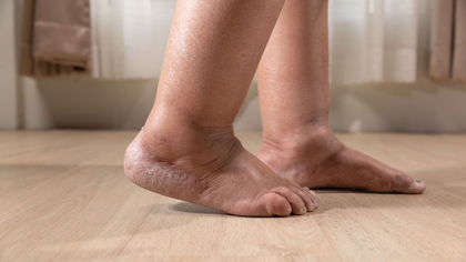 Bilateral leg swelling evaluation and care in Hyderabad