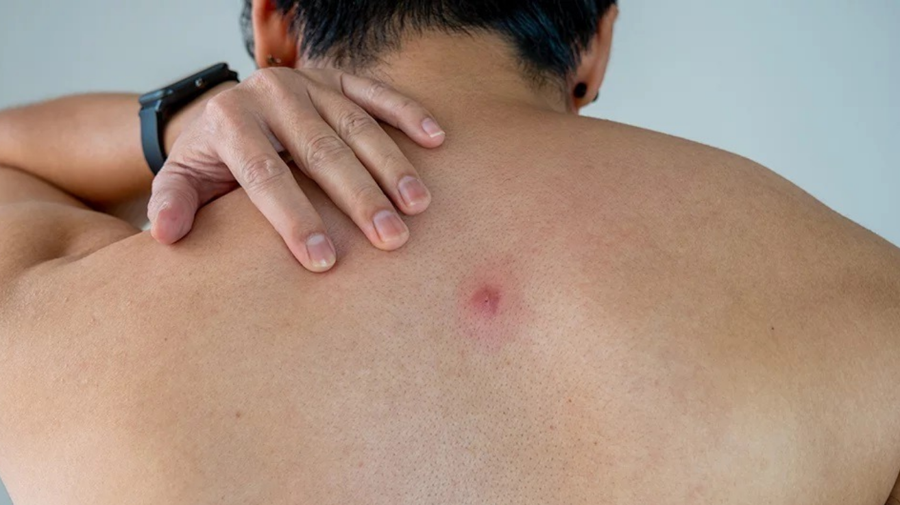 Skin abscess drainage and infection care in Hyderabad