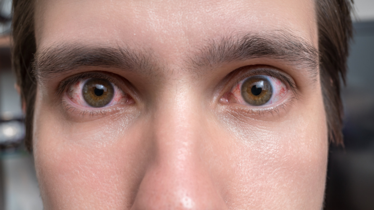Graves' disease thyroid and eye evaluation in Hyderabad