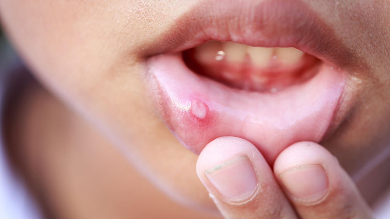 Mouth ulcer (canker sore) assessment and care in Hyderabad