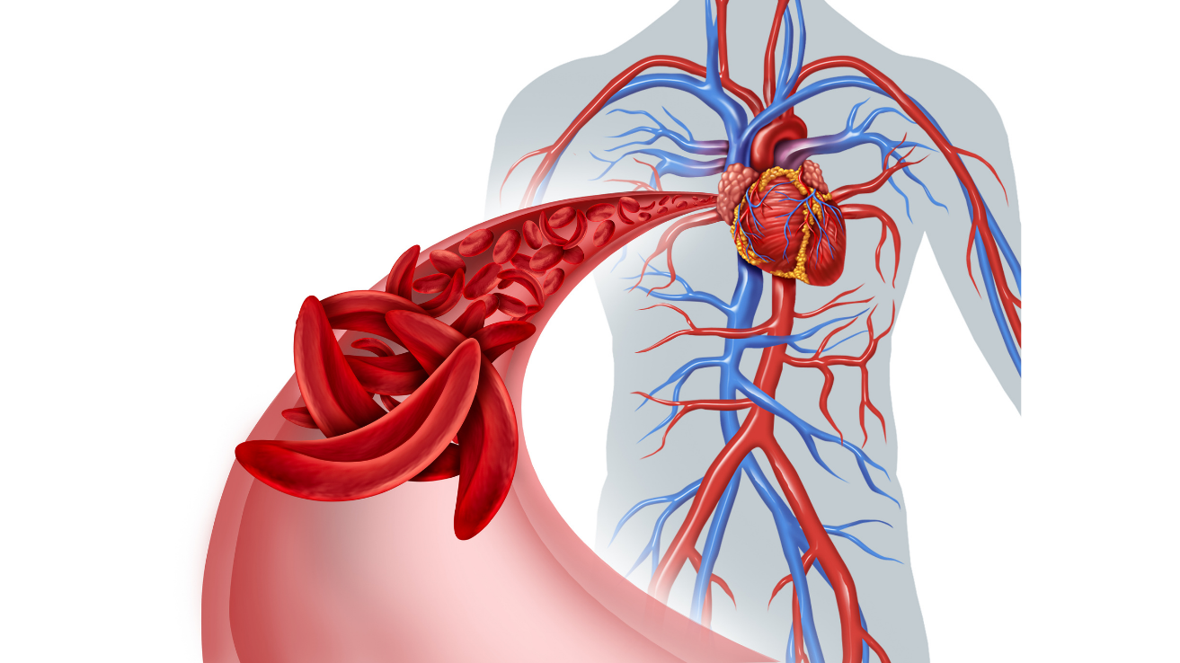 Sickle cell disease evaluation and lifelong care in Hyderabad