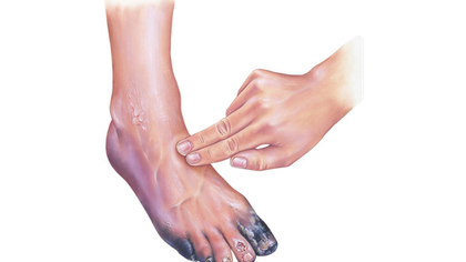 Peripheral vascular disease (PVD) evaluation in Hyderabad