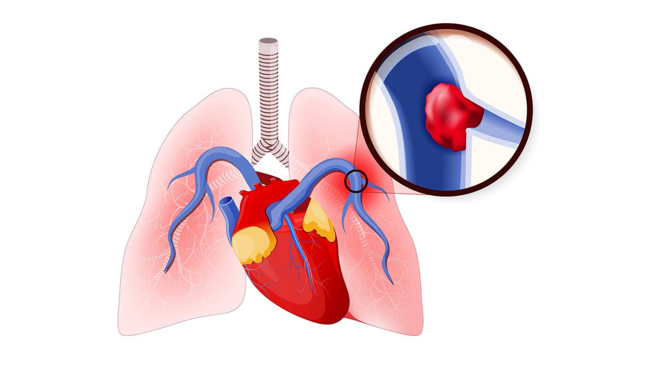 Pulmonary embolism lung clot emergency evaluation in Hyderabad