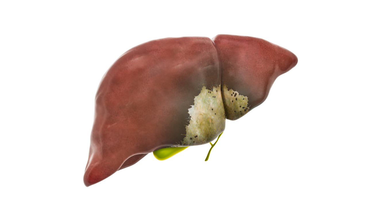Hepatitis A liver infection evaluation in Hyderabad