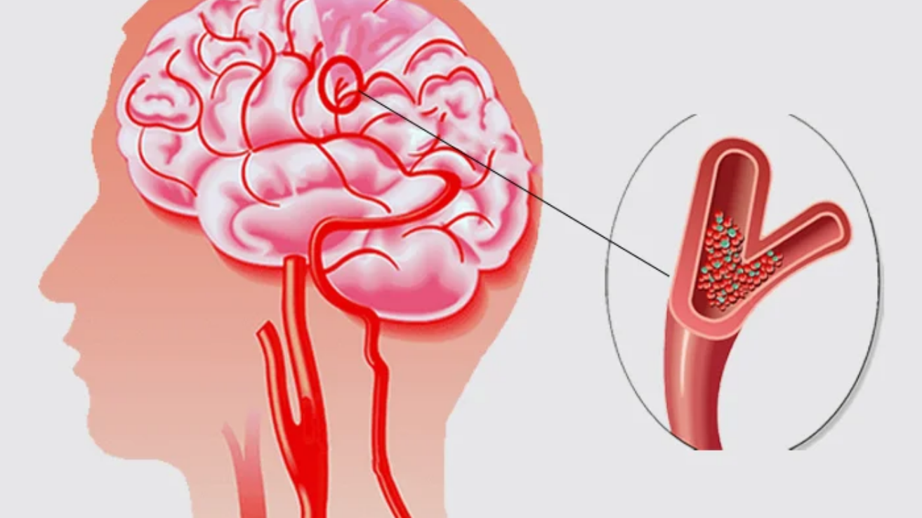 Transient ischemic attack (TIA) urgent care in Hyderabad