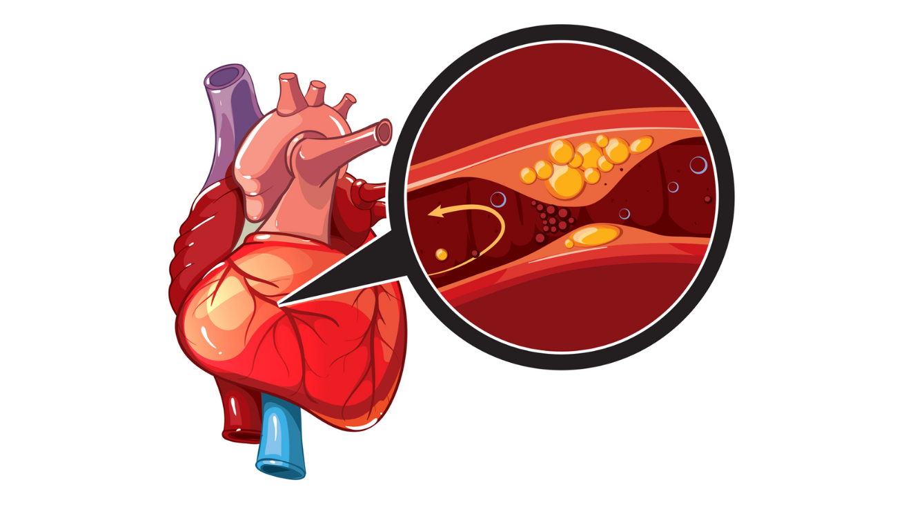 Coronary artery disease (CAD) heart evaluation in Hyderabad