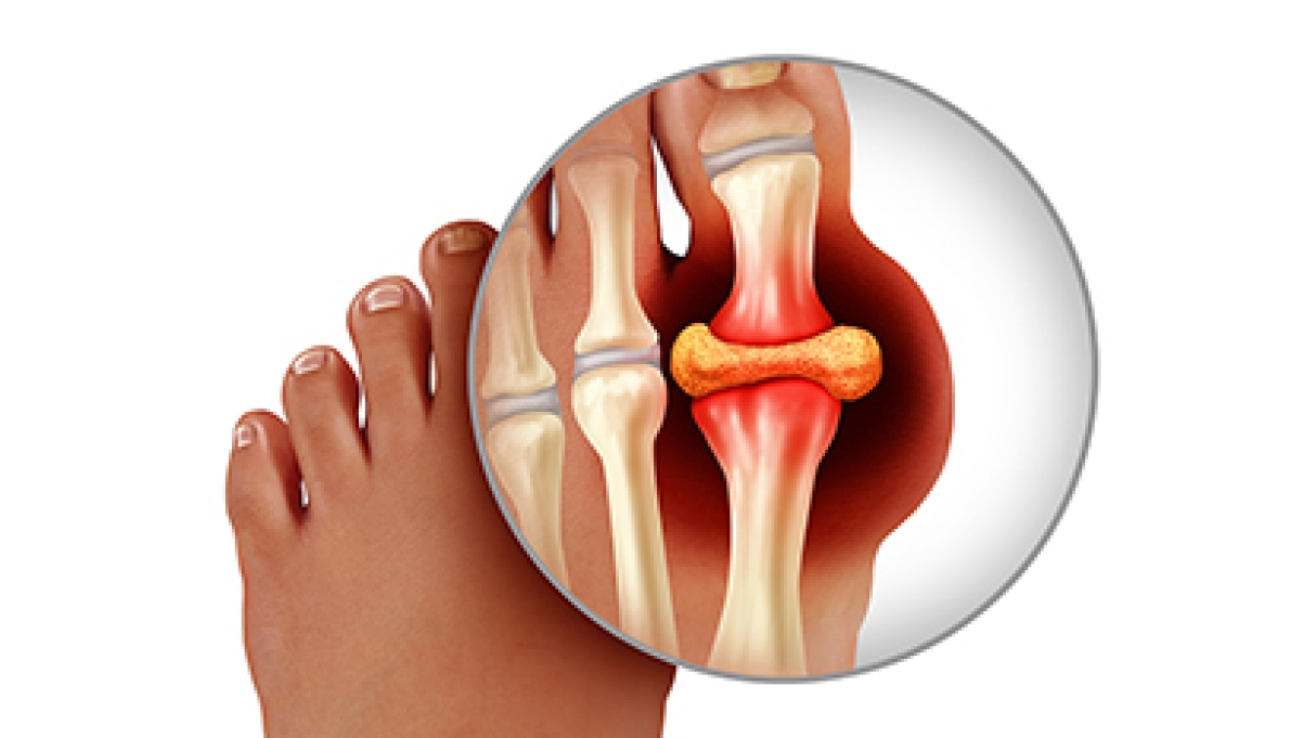 Hyperuricemia uric acid evaluation and care in Hyderabad