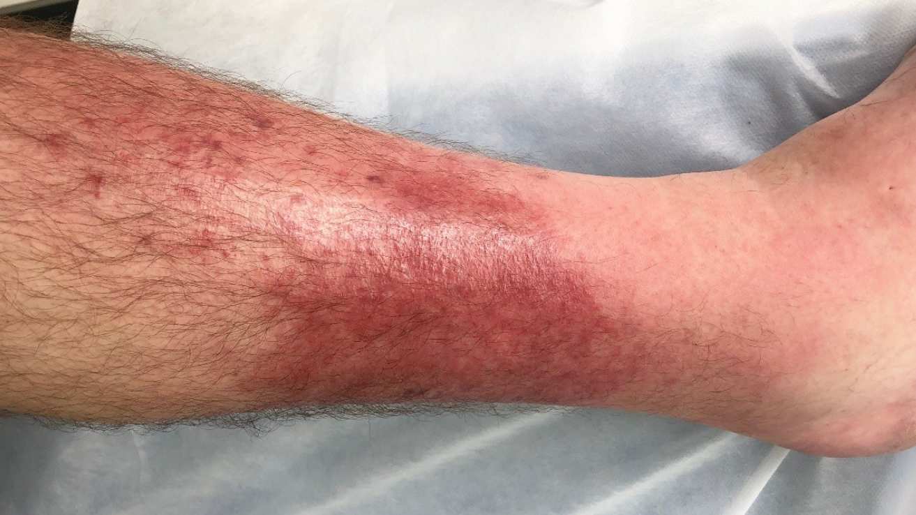 Cellulitis skin infection evaluation in Hyderabad