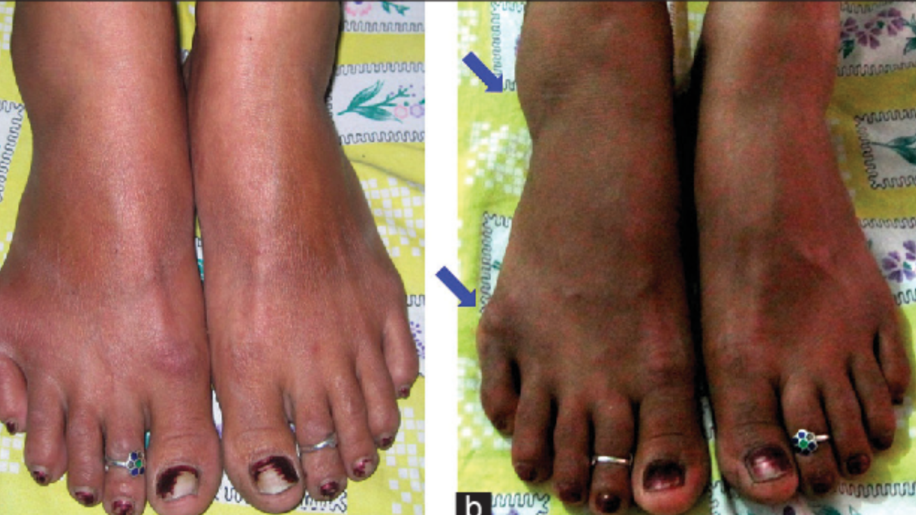Brucellosis fever and joint pain evaluation in Hyderabad
