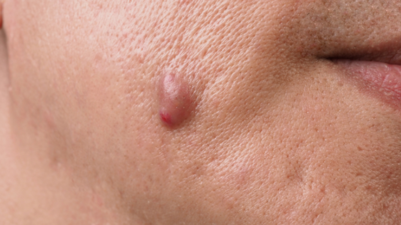 Actinomycosis abscess evaluation and care in Hyderabad