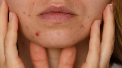 Sjögren's syndrome dry eye and mouth evaluation in Hyderabad