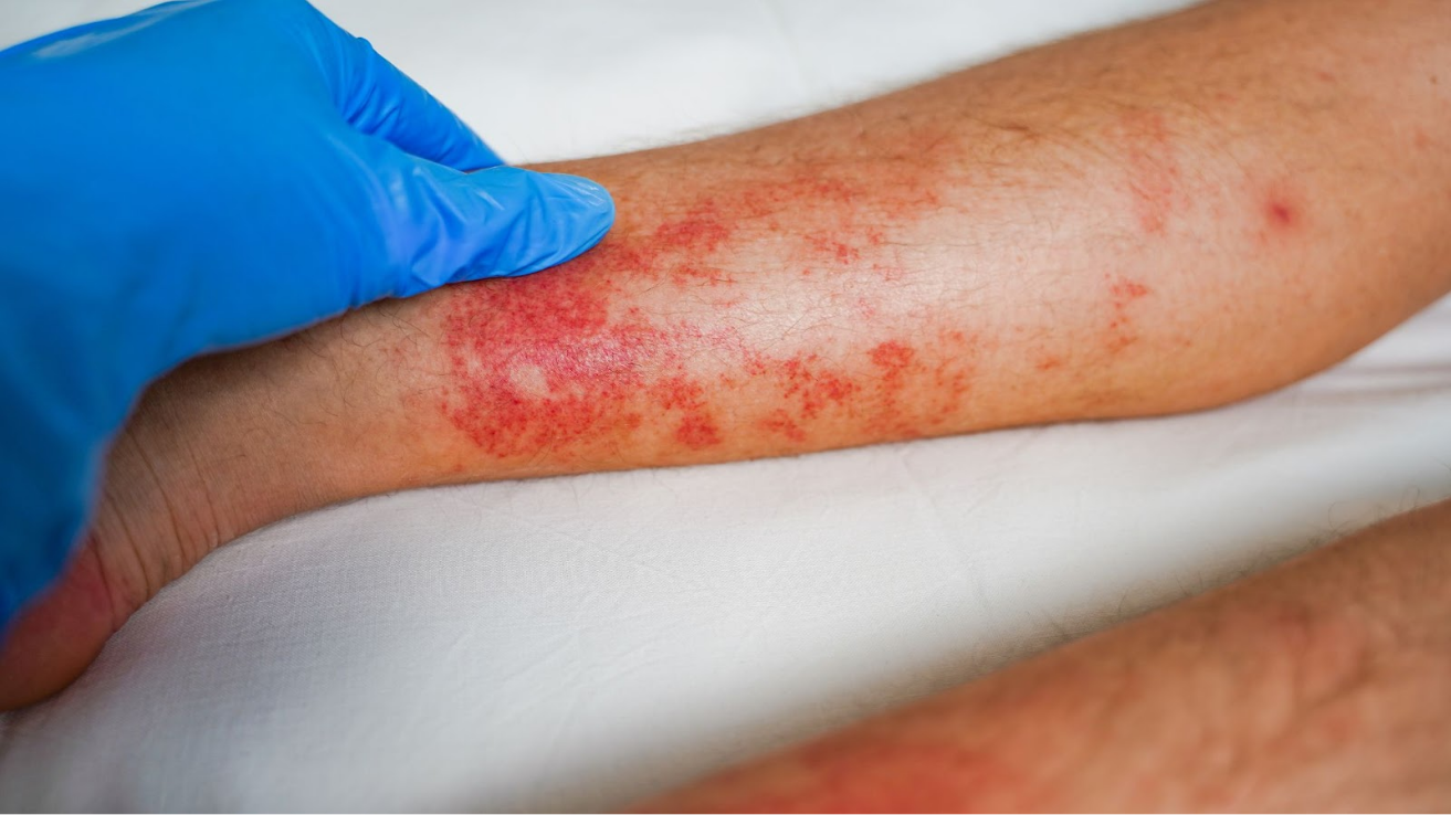 Leptospirosis fever and jaundice evaluation in Hyderabad