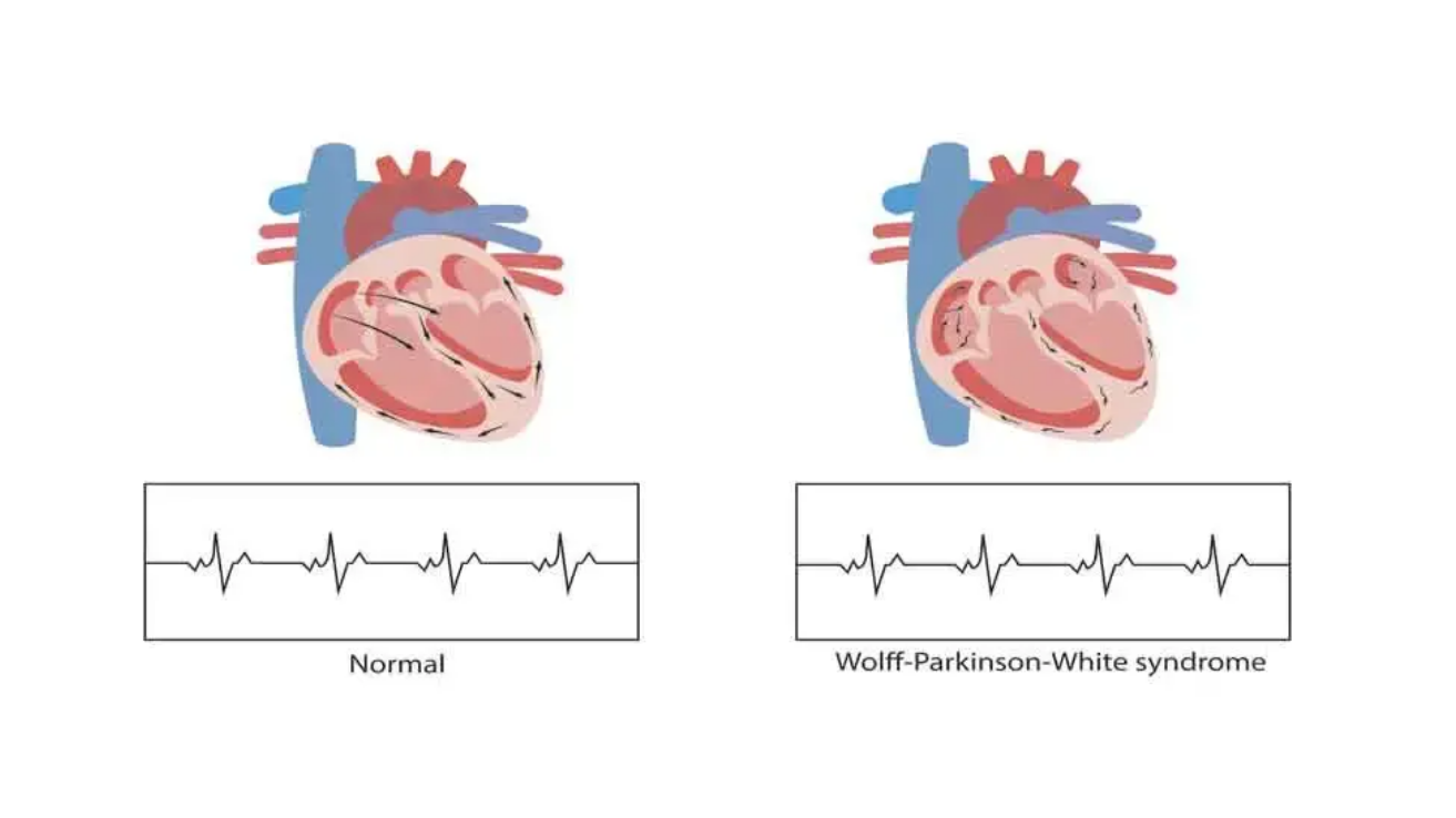 Wolff-Parkinson-White (WPW) syndrome evaluation in Hyderabad