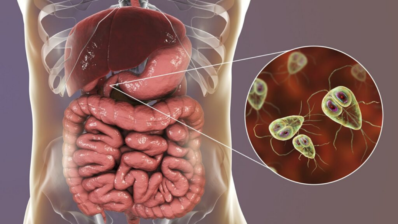 Giardiasis diarrhoea and bloating evaluation in Hyderabad