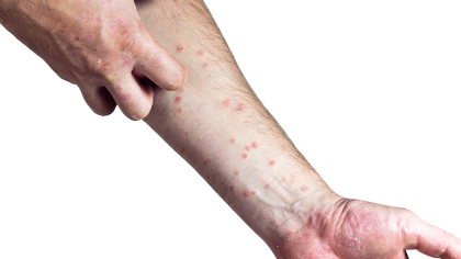 Leukocytosis (high WBC) blood test and assessment in Hyderabad