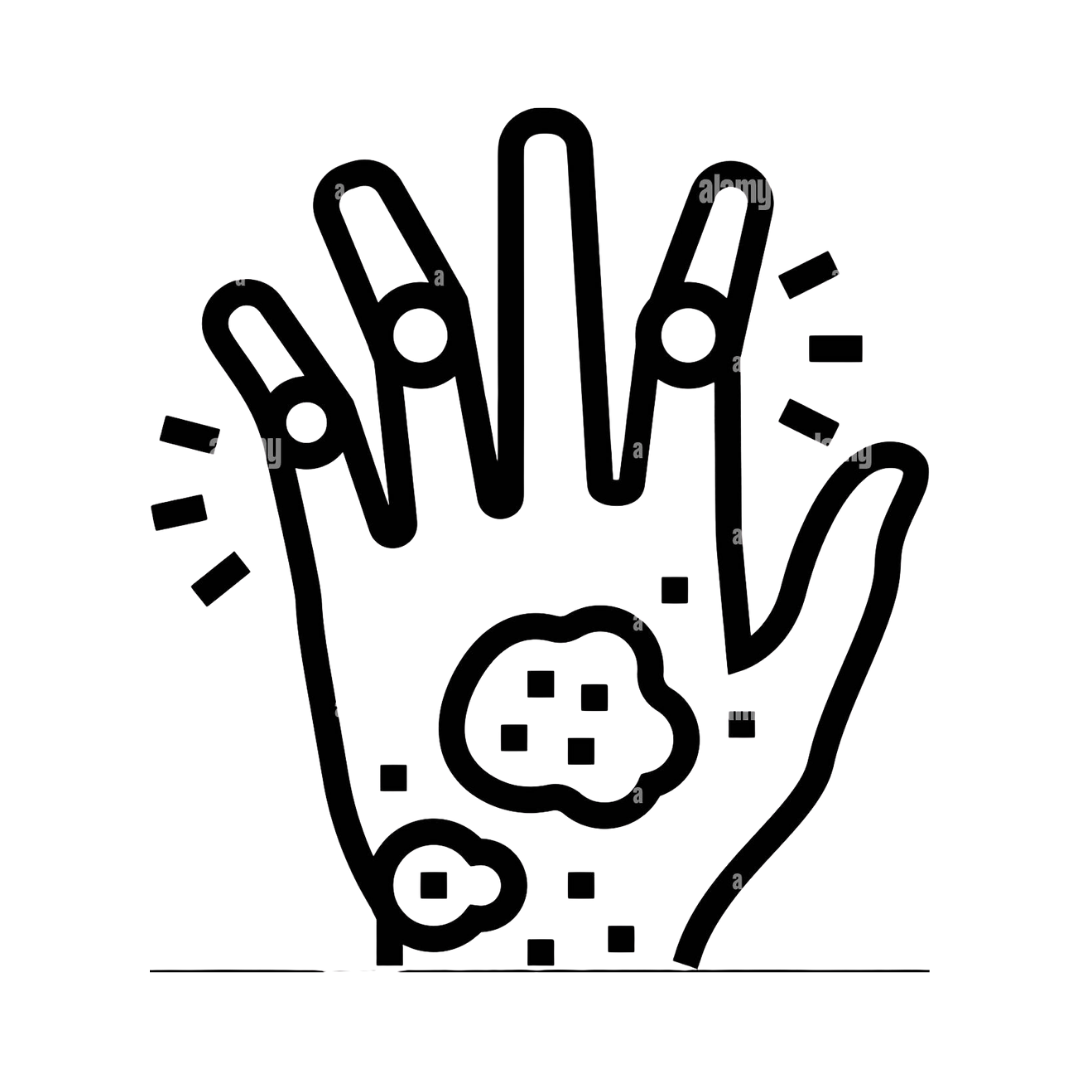 Psoriatic Arthritis