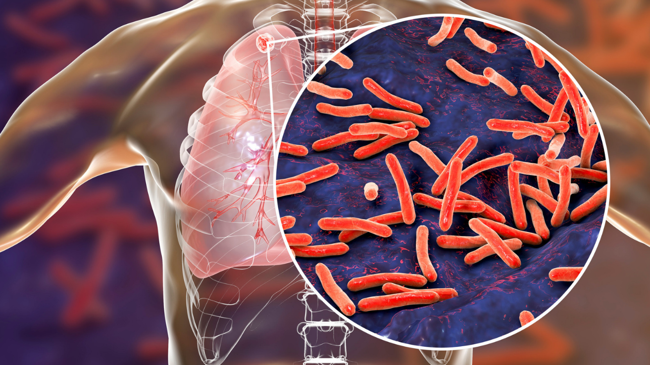 Tuberculosis (TB) diagnosis and treatment in Hyderabad