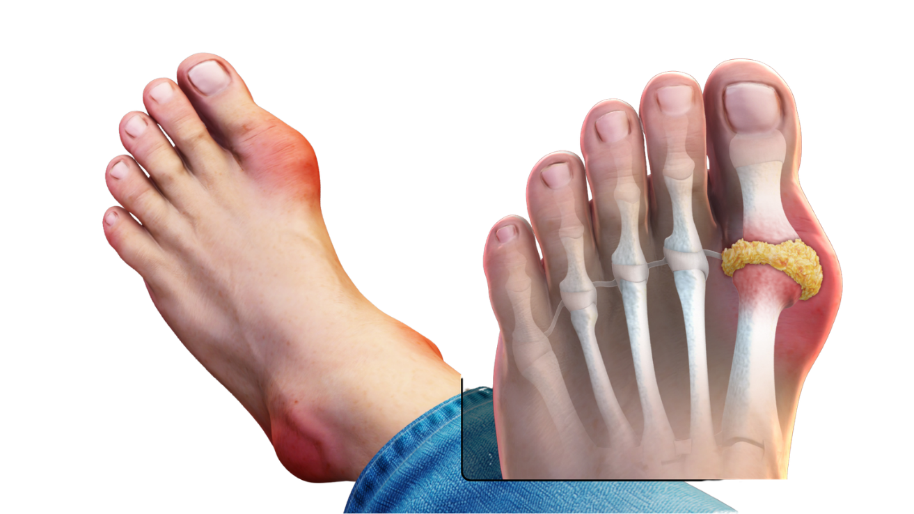 Gout joint pain and swelling evaluation in Hyderabad