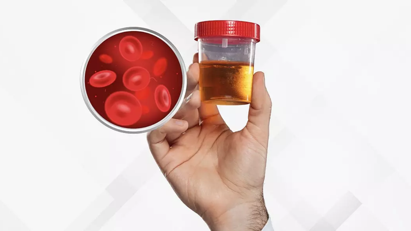 Hematuria (blood in urine) assessment in Hyderabad