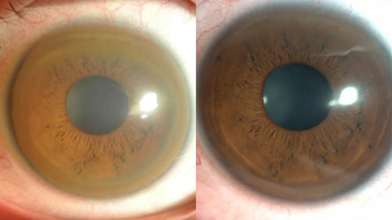 Wilson disease copper-disorder evaluation in Hyderabad