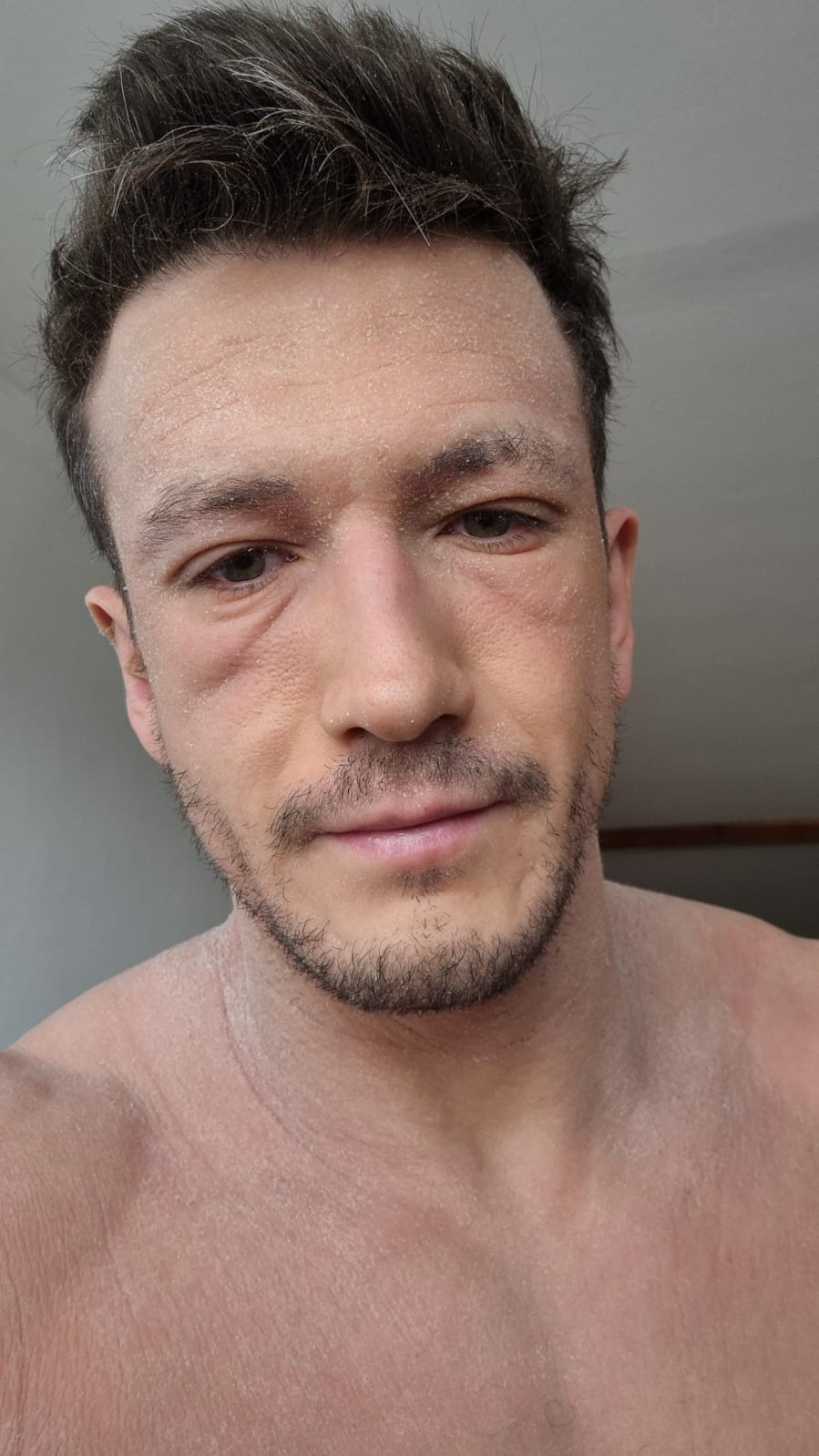 solfronk jan atopicky ekzem