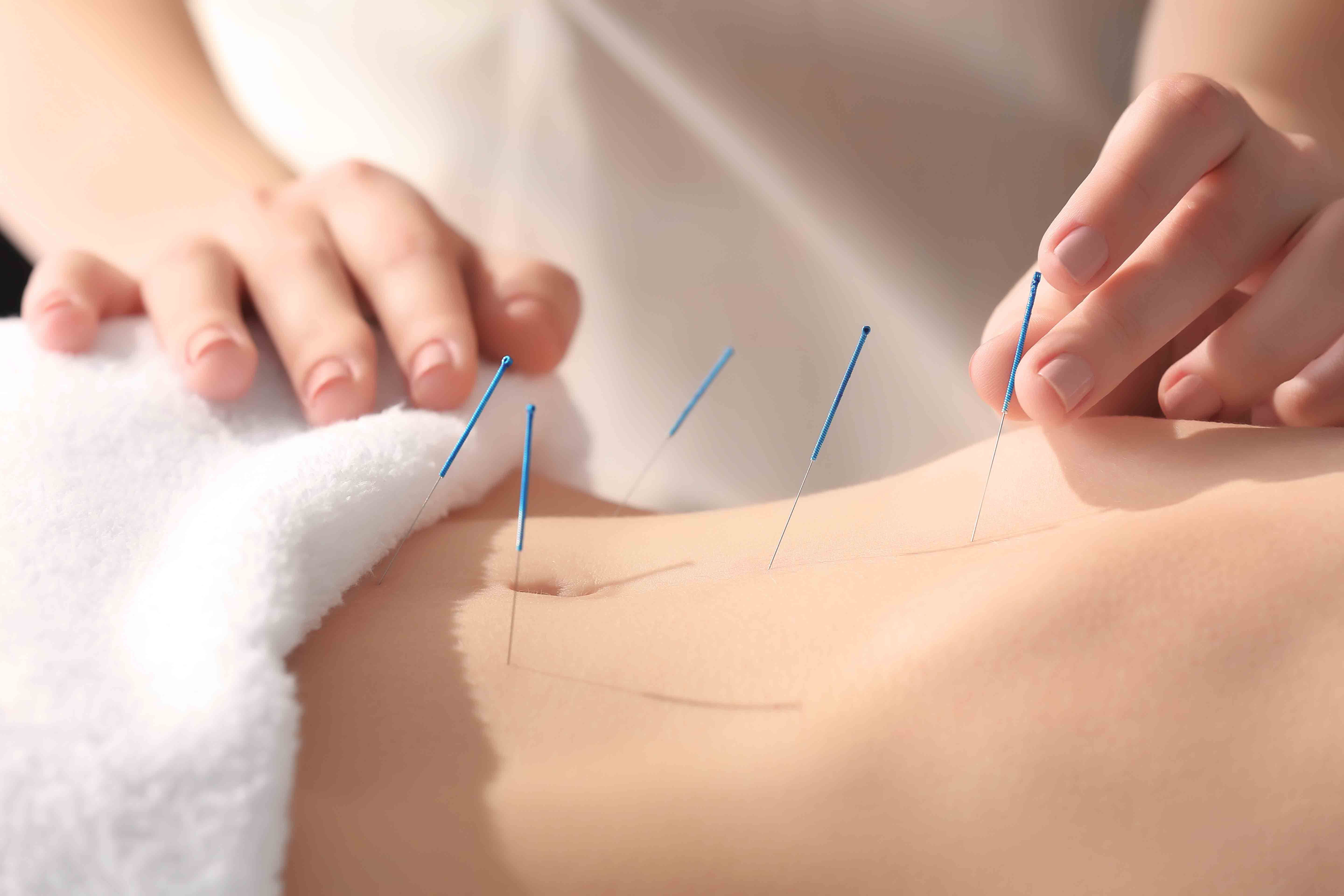 akupunktura k hubnutí