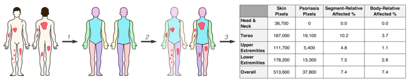 SPREAD Framework overview diagram showing the progression from full-body photograph through body segmentation, patch formation, spread and severity analysis, to final metric aggregation table