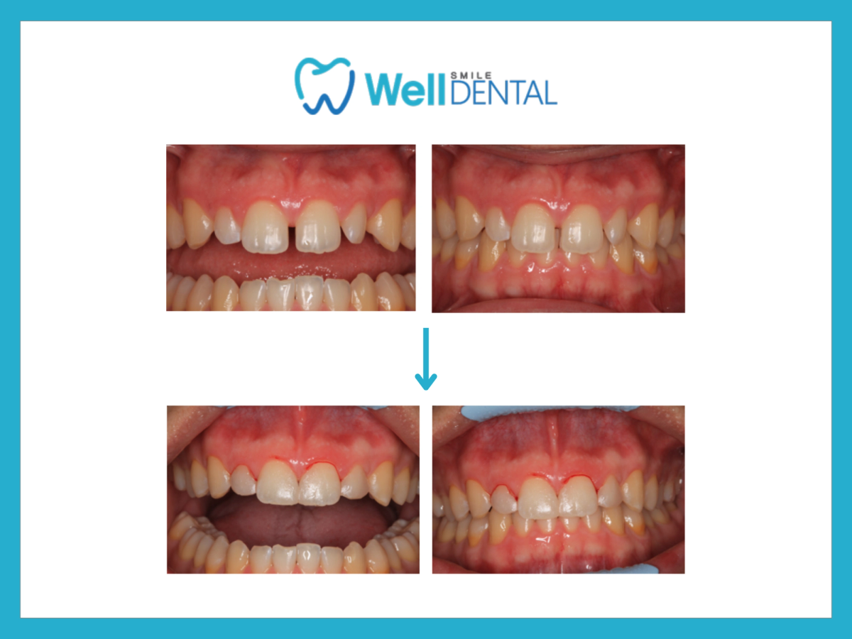Before and after front teeth gap closure with dental bonding at Smile Well Dental BC