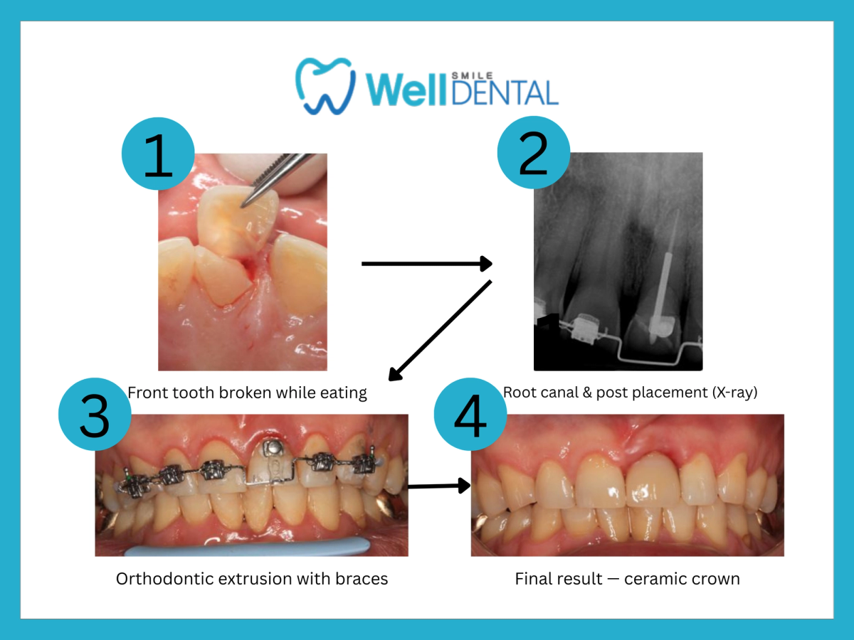Before and after broken front tooth treatment with root canal, orthodontics, and ceramic crown at Smile Well Dental