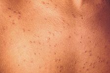 Heat - Heat rash blisters on skin