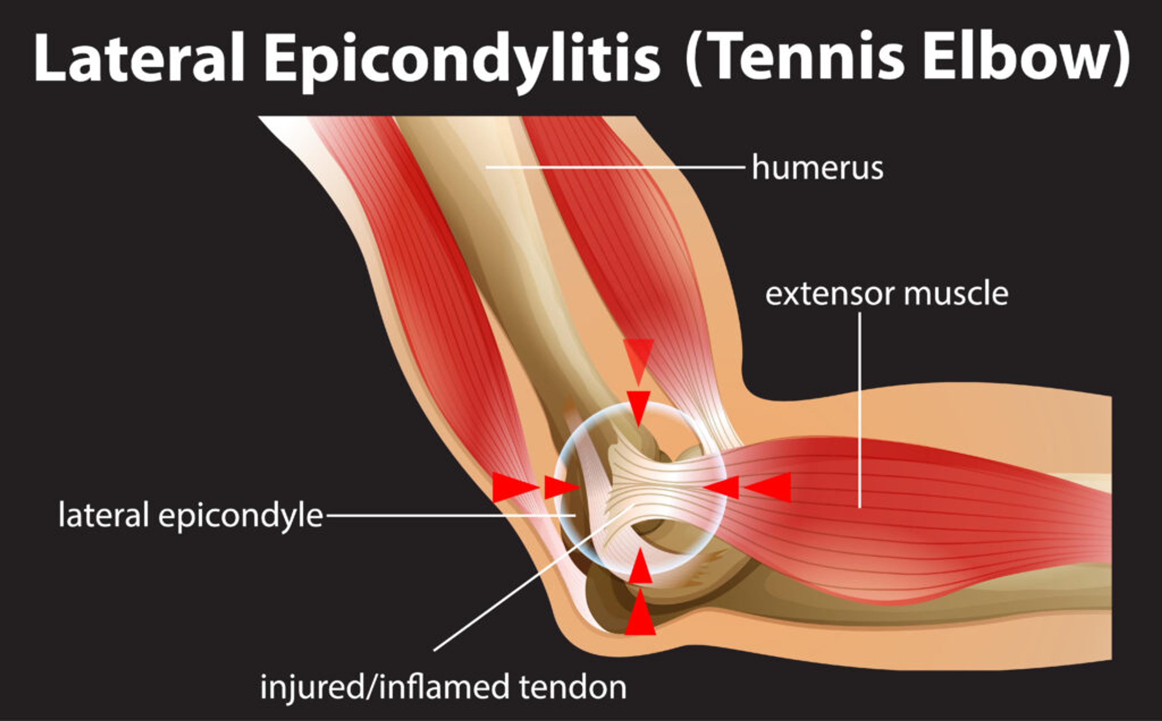 Lateral epicondylitis (tennis elbow) anatomy illustration showing affected tendons in the elbow