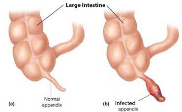 Doctor Faces Lawsuit for Failure to Diagnose Child Appendicitis in New York