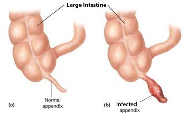 Doctor Faces Lawsuit for Failure to Diagnose Child Appendicitis in New York