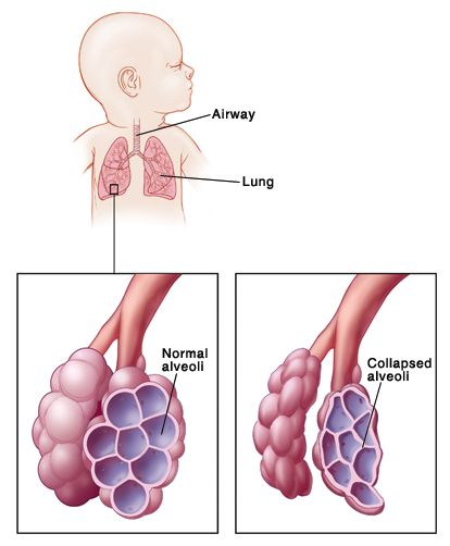 Our Attorneys Obtain $3.825 Million on Behalf of Infant Respiratory Distress Victim