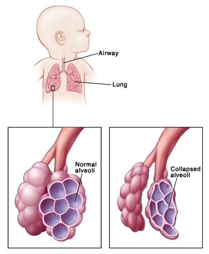 Our Attorneys Obtain $3.825 Million on Behalf of Infant Respiratory Distress Victim